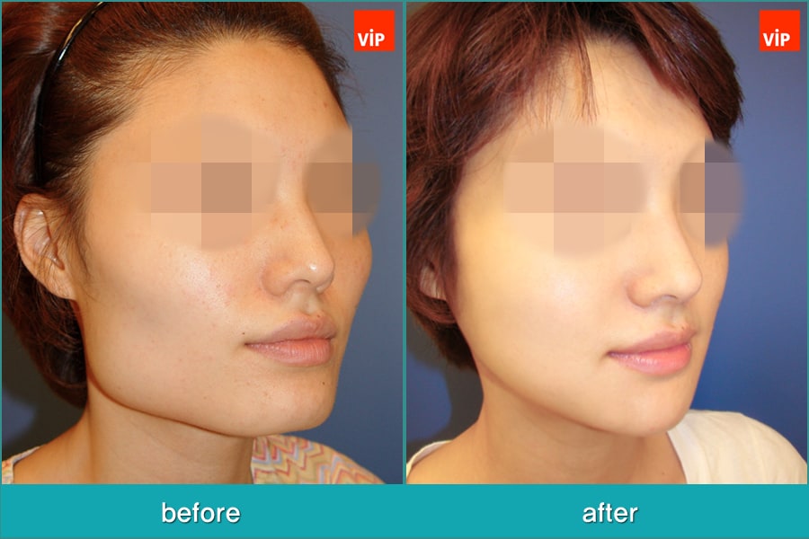 Nose Surgery, Facial Bone Surgery - Искривление перегородки, Контурная хирургия лица, V-линия