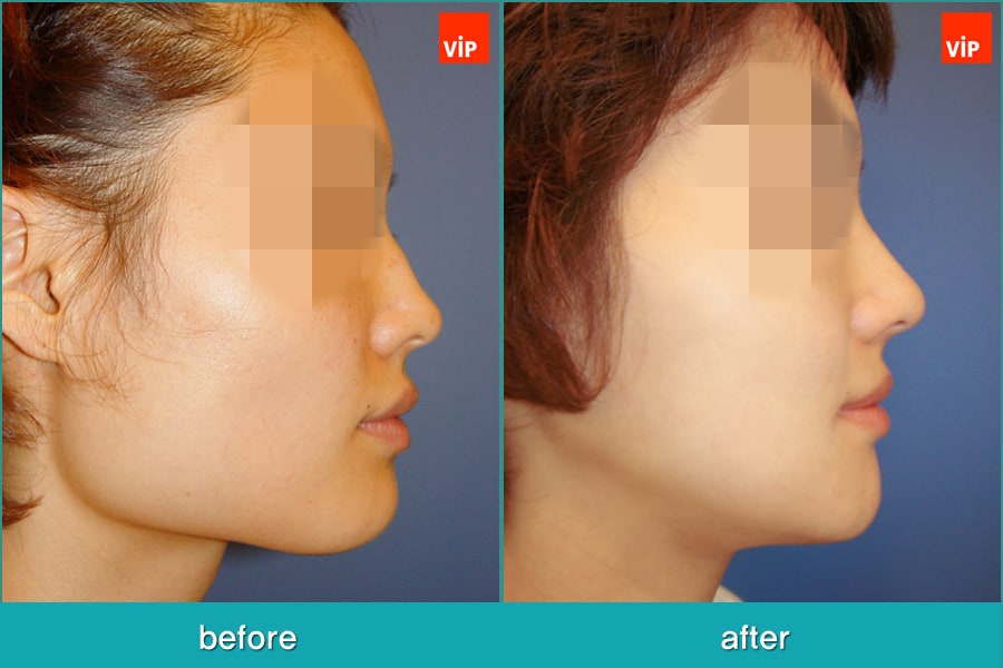 Nose Surgery, Facial Bone Surgery - Искривление перегородки, Контурная хирургия лица, V-линия