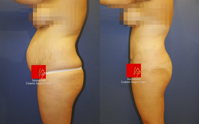 Body Contouring - Контуринг тела | Абдоминальная пластика с липосакцией