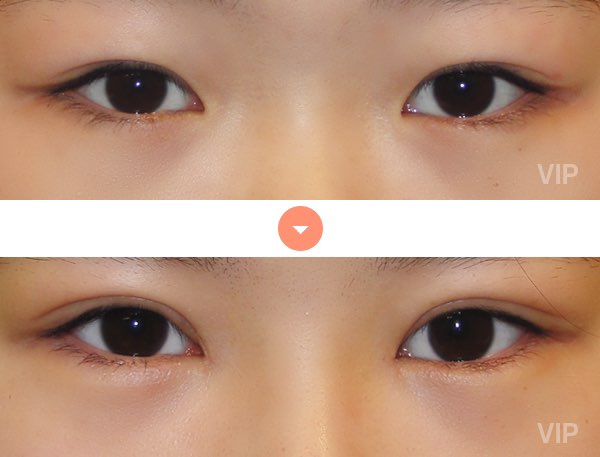 Eye Surgery - Double Eyelid Surgery