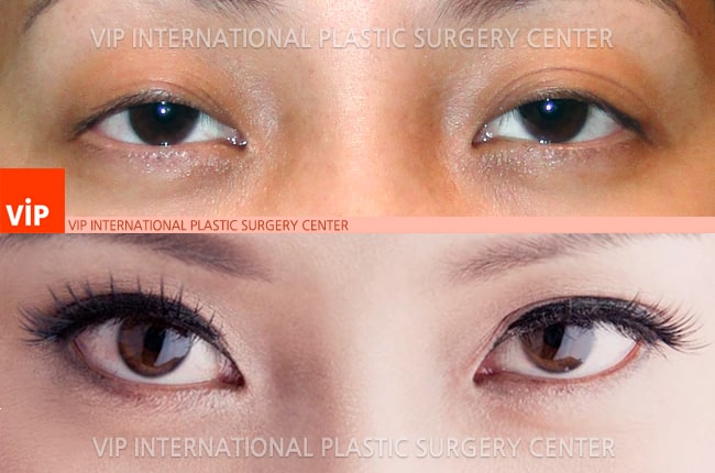 Eye Surgery - Коррекция тяжелой формы птоза