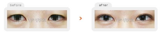 Eye Surgery - Создание "двойного века" (сангапури, сангопуль) с разрезом