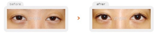 Eye Surgery - Повторная операция по созданию "двойного века" с разрезом