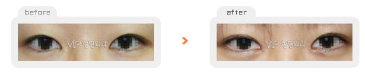 Eye Surgery - Операция "двойное веко" без разреза
