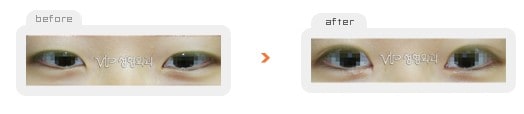 Eye Surgery - Операция "двойное веко" без разреза