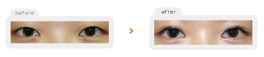 Eye Surgery - Операция "двойное веко" без разреза
