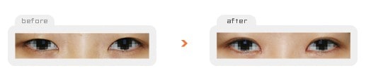 Eye Surgery - Эпикантопластика