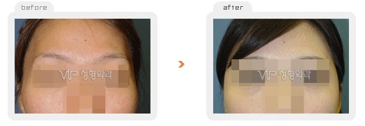 Stem Cell Fat Graft - Липофилинг стволовыми клетками на лбу и висках
