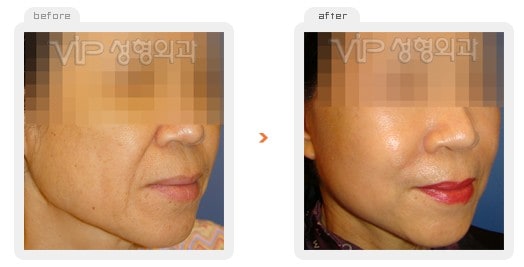 Face Lift - Подтяжка лица