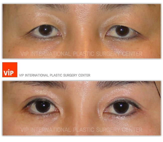 Eye Surgery - Коррекция птоза верхнего века