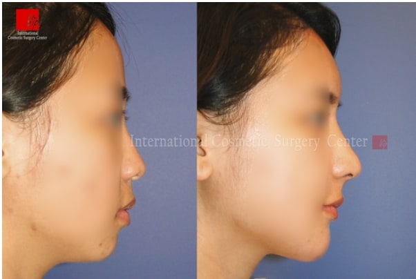 Nose Surgery, Stem Cell Fat Graft - Ринопластика с использованием аутологичного материала и липофилинг