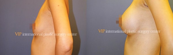 Breast Surgery - Операция по увеличению груди