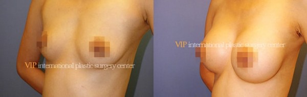 Breast Surgery - Операция по увеличению груди