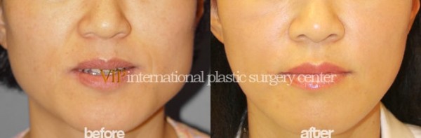 Facial Bone Surgery - Челюстно-лицевая хирургия, уменьшение квадратной челюсти