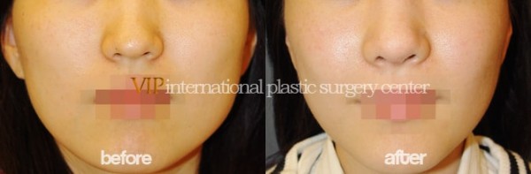Facial Bone Surgery - Челюстно-лицевая хирургия, уменьшение скул