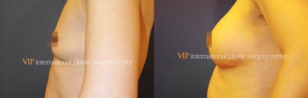 Breast Surgery - Операция по увеличению груди