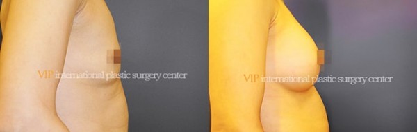 Breast Surgery - Операция по увеличению груди
