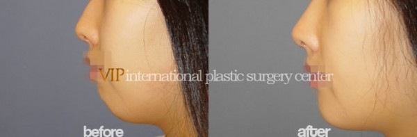 Facial Bone Surgery - Челюстно-лицевая хирургия, гениопластика
