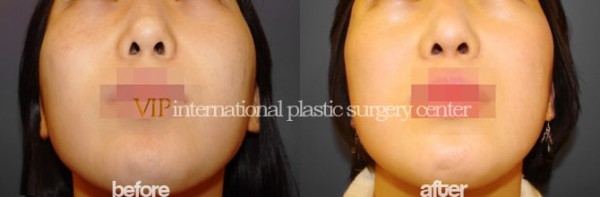 Facial Bone Surgery - Челюстно-лицевая хирургия, уменьшение скул