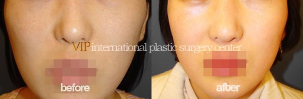 Facial Bone Surgery - Челюстно-лицевая хирургия, уменьшение скул
