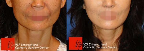 Face Lift - Подтяжка лица