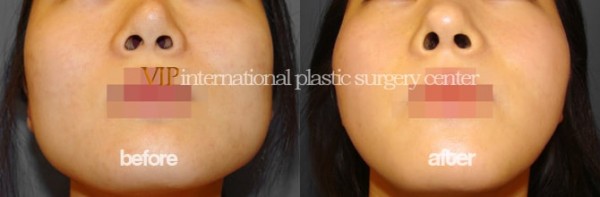 Facial Bone Surgery - Челюстно-лицевая хирургия, уменьшение скул и челюсти