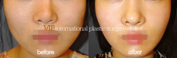 Facial Bone Surgery - Челюстно-лицевая хирургия, уменьшение скул и челюсти