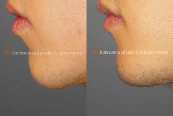 Facial Bone Surgery - Челюстно-лицевая хирургия, гениопластика