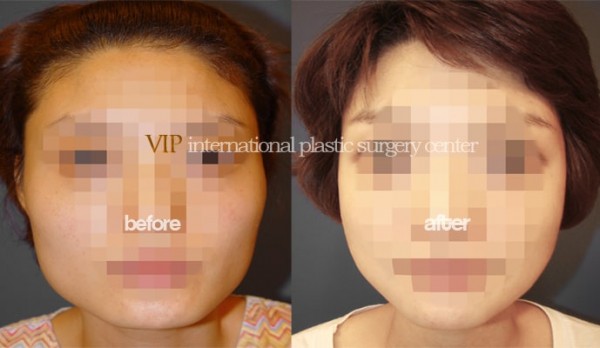 Facial Bone Surgery - Челюстно-лицевая хирургия, коррекция асимметрии челюсти