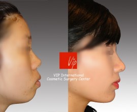 VIP Harmony rhinoplasty ( small, upturned & protruded mouth …