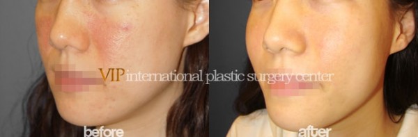Facial Bone Surgery - Челюстно-лицевая хирургия, увеличение скул