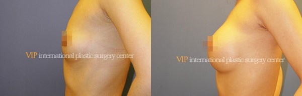 Breast Surgery - Увеличение груди до и после