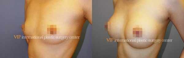 Breast Surgery - Увеличение груди до и после