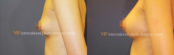 Breast Surgery - Операция по увеличению груди