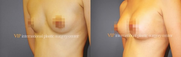 Breast Surgery - Операция по увеличению груди