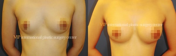 Breast Surgery - Операция по увеличению груди