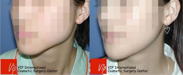 Facial Bone Surgery - Уменьшение квадратной челюсти