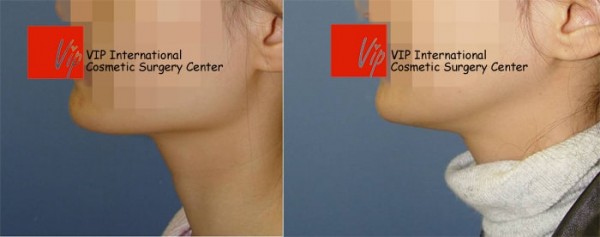 Facial Bone Surgery - Уменьшение квадратной челюсти