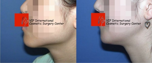 Facial Bone Surgery - Уменьшение квадратной челюсти