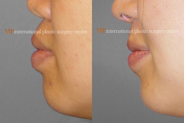 Facial Bone Surgery - Челюстно-лицевая хирургия, коррекция выступающего рта