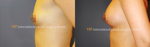 Breast Surgery - Операция по увеличению груди