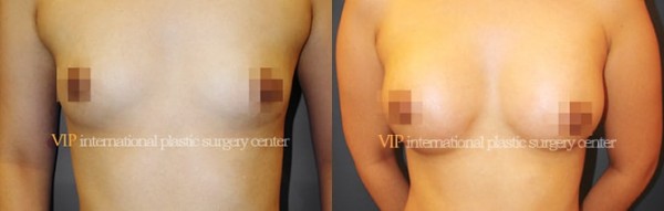 Breast Surgery - Операция по увеличению груди