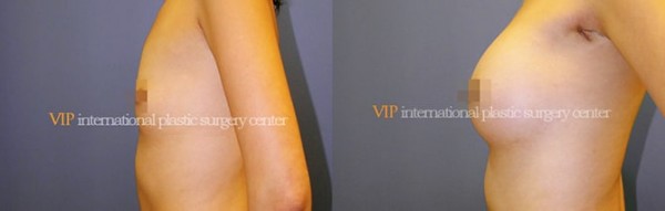 Breast Surgery - Увеличение груди до и после
