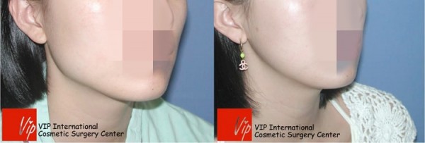 Facial Bone Surgery - Челюстно-лицевая хирургия, уменьшение квадратной челюсти