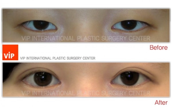 Eye Surgery - Коррекция птоза