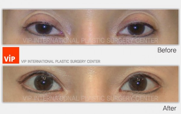 Eye Surgery - Коррекция птоза до и после