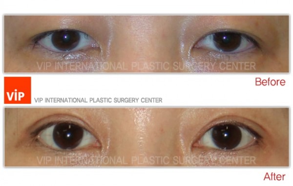 Eye Surgery - Создание &#034;двойного века&#034; и Коррекция птоза