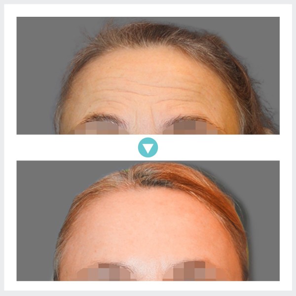 Face Lift - Подтяжка лица | Эндоскопическая подтяжка лба
