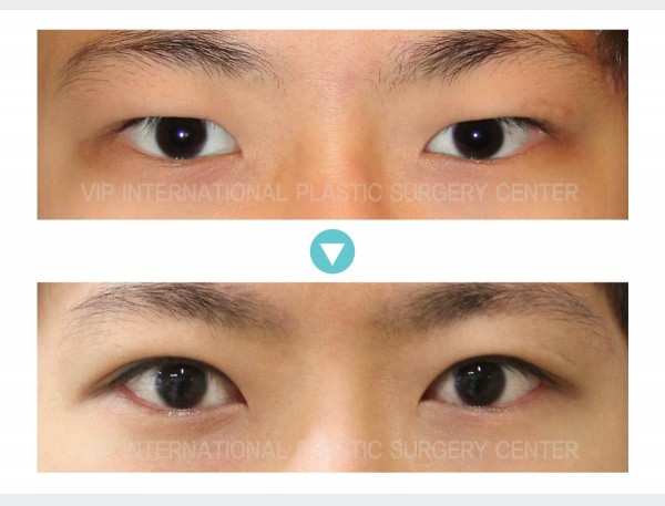 Eye Surgery - Мужская коррекция птоза - двойное векоу мужчин
