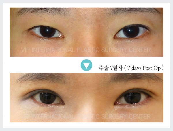 Eye Surgery - Блефаропалстика через 7 дней после операции